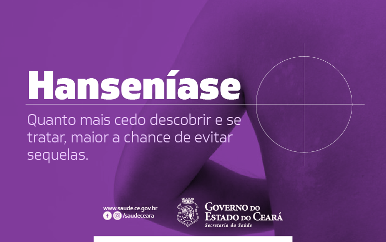 Apresentação clínica da hanseníase: saiba como diferenciar