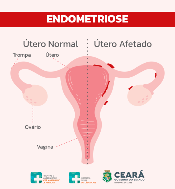 Menstruação: fluxo intenso é normal? Ginecologista esclarece